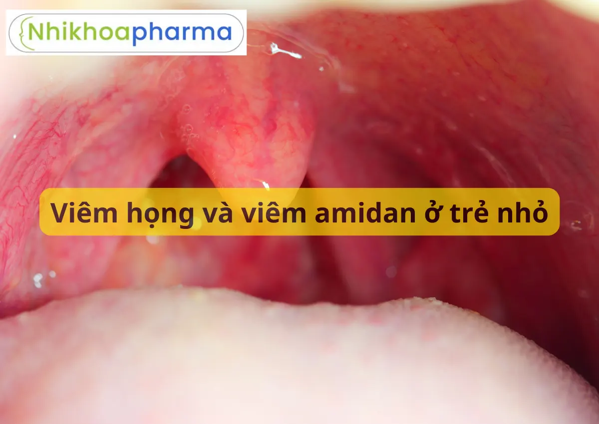 Viêm họng và viêm amidan ở trẻ nhỏ